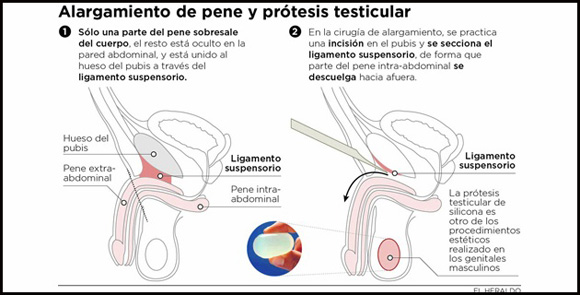 24-tend-alargamiento_de_pene_y_protesis_testicular_copia